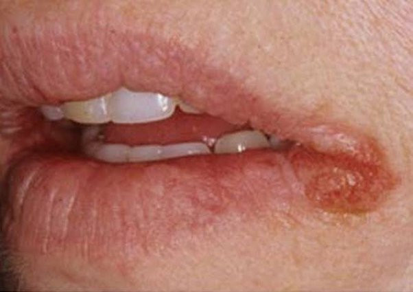 Stomatitis Angularis